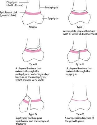 Management of pediatric ankle fractures: comparison of biodegradable PLGA implants with traditional metal screws